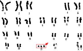 tres cromosomas en el par 21
